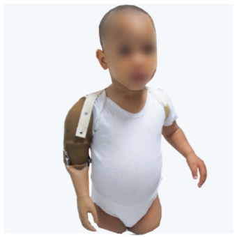 Prothèses des membres supérieurs